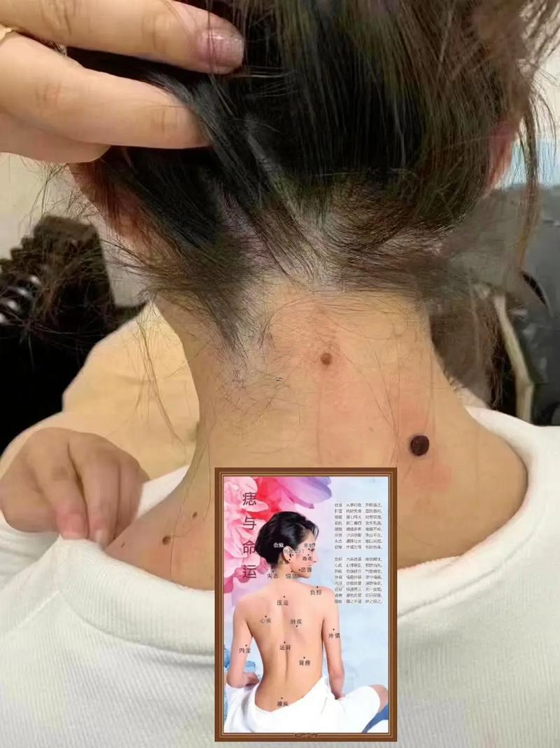 脖子長(zhǎng)痣